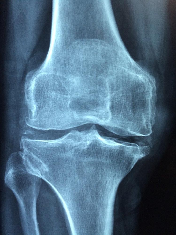 Jak długo wraca się do zdrowia po artroskopii kolana?