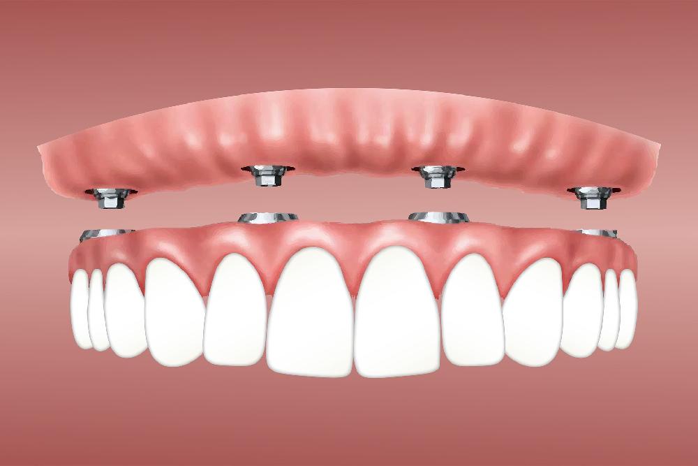 W jaki sposób zakłada się implanty stomatologiczne?